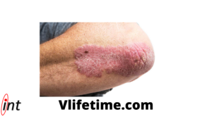 psoriasis-7-important-things-you-need-to-know-about-psoriasis