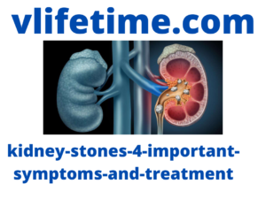kidney-stones-4-important-symptoms-and-treatment